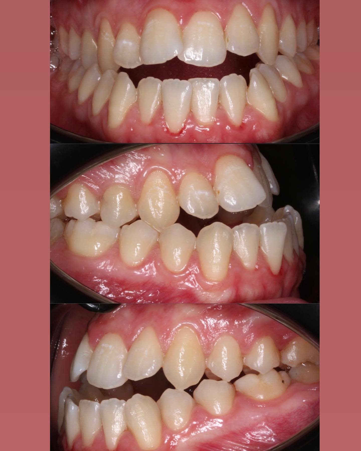 Estetica dentale Manfredonia - faccette in ceramica Hollywood Smile