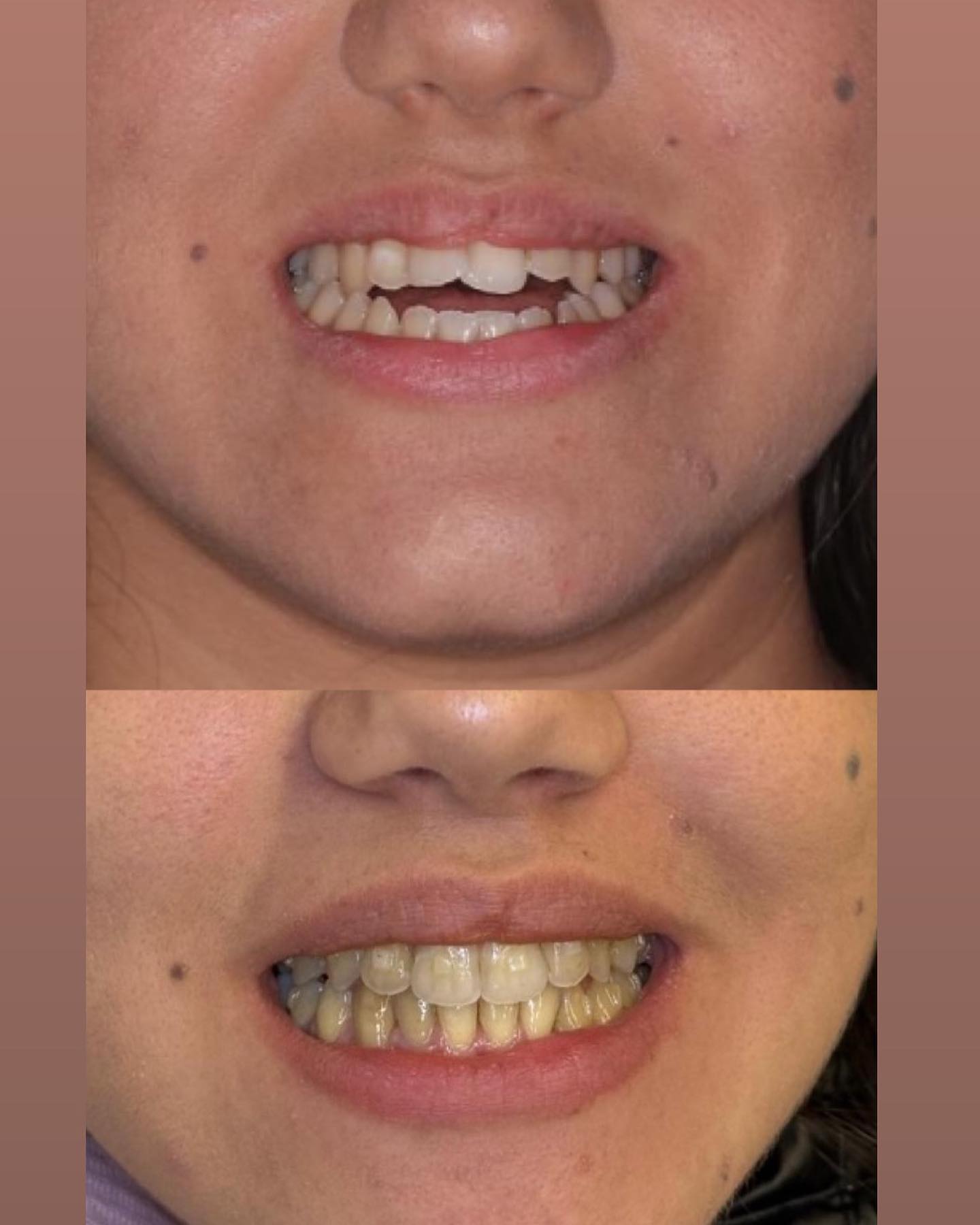 Implantologia Manfredonia - riabilitazione completa arcata superiore con impianti in titanio