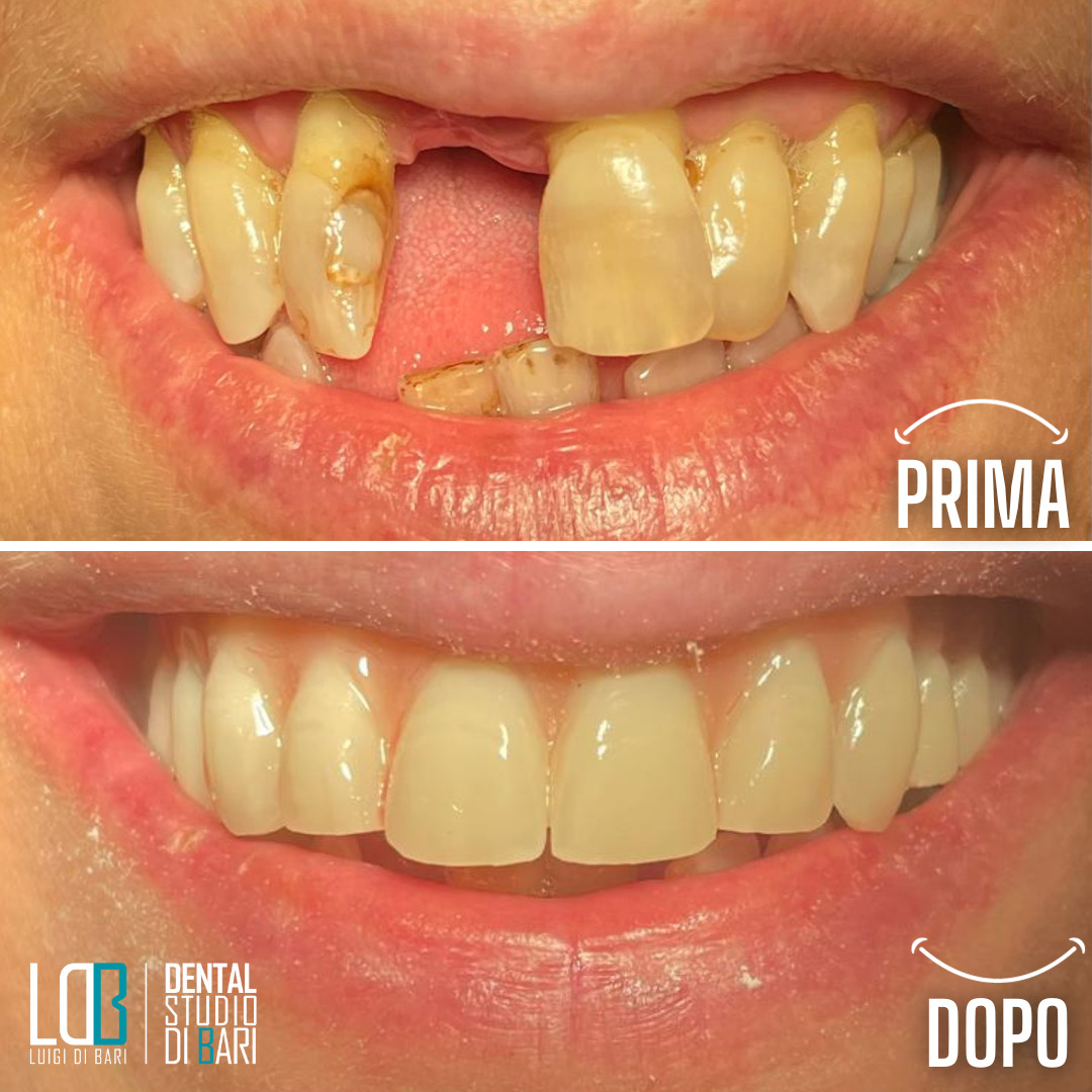 Ortodonzia Manfredonia - allineatori invisibili correzione del morso