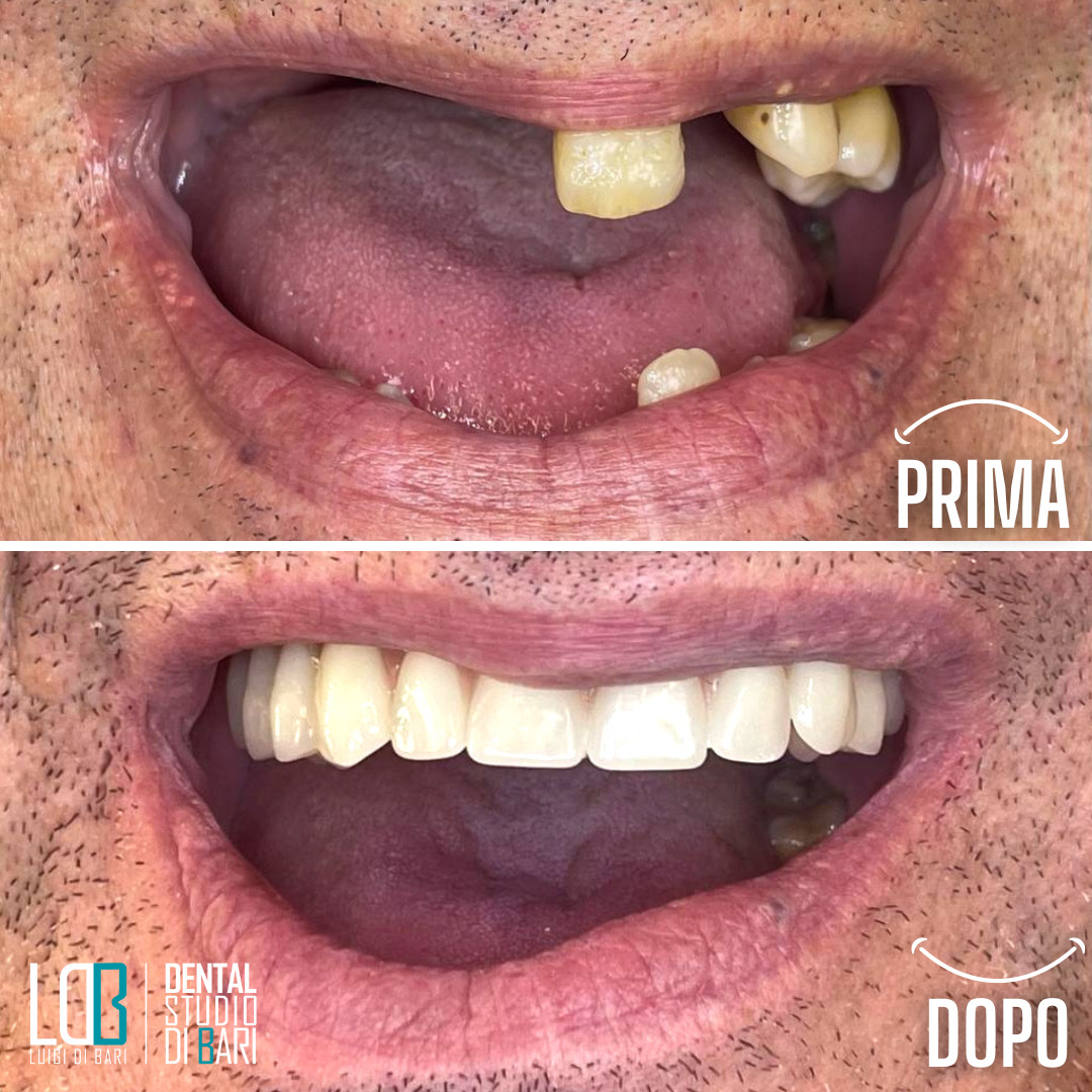 Protesi dentaria dopo - riabilitazione fissa su impianti Manfredonia