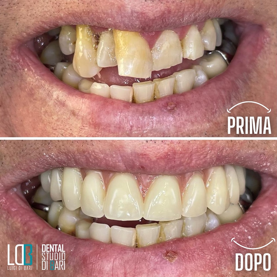 Sbiancamento professionale dopo - denti bianchi e luminosi Manfredonia